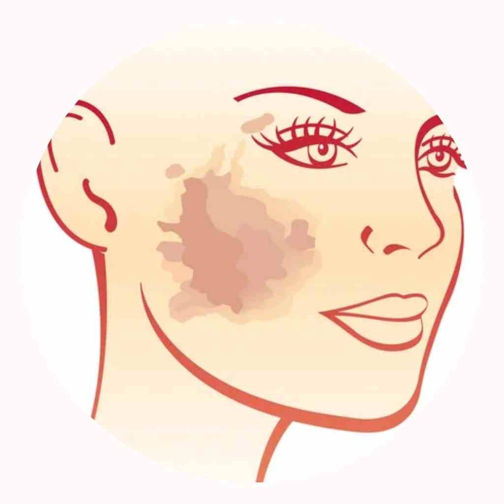 skin concerns hyperPigmentation