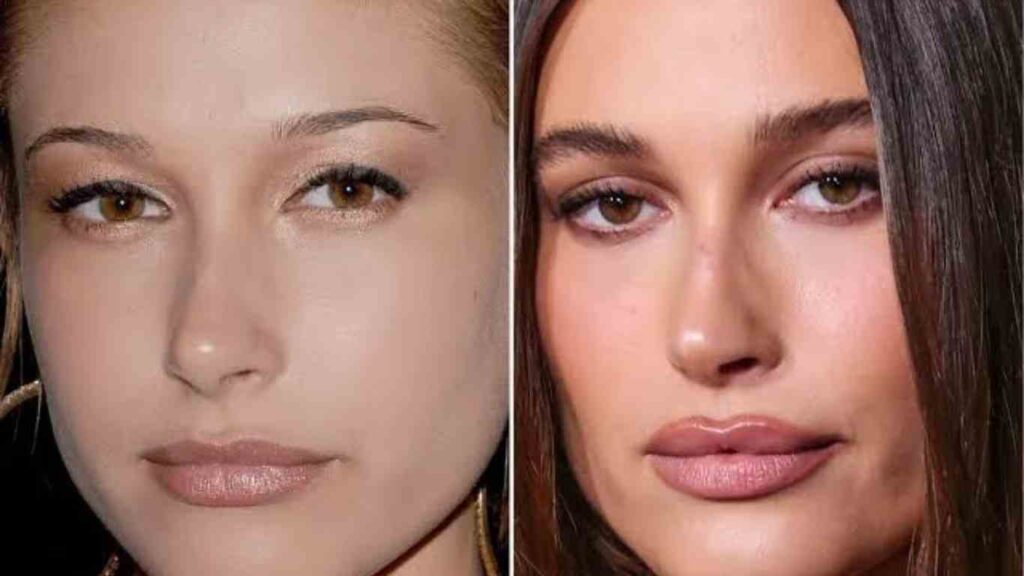 Asian blepharoplasty (double eyelid surgery) in this complete guide